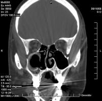 CT Scan after drainage of a large maxillary sinus mucocele
