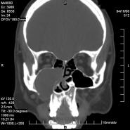 CT Scan of a large maxillary sinus mucocele