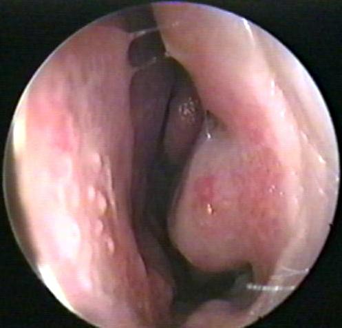 Picture of Nasal Mucosa in Chroinic Allergic Rhinitis