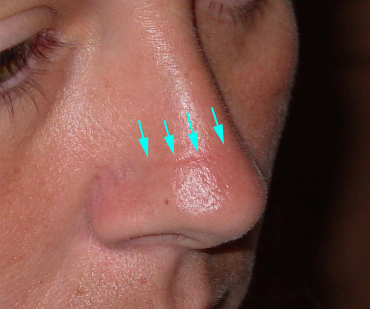 Picture of an allergic crease in nasal allergy