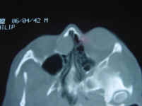 CT Scan Ethmoid Sinus Mucocele
