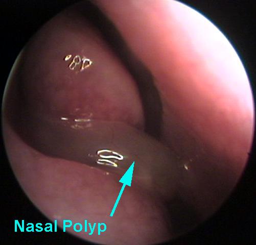 Picture of a Nasal Polyp