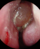 Photograph of Polyps in Nose