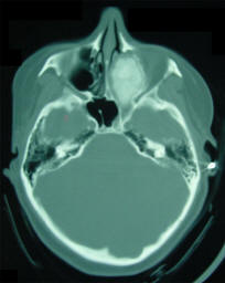 Ossifying Fibroma of Ethmoid Sinuses