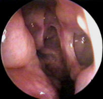 Appearance of Nasal Cavity After Functional Endoscopic Sinus Surgery - FESS