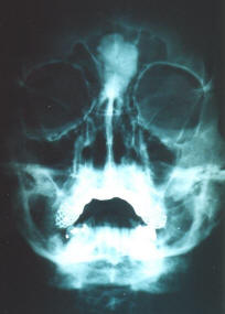 Frontal Sinus Osteoma X-Ray