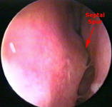 Nasal Septal Spur