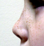 Saddle Deformity of the Nose Caused by Nasal Septal Hematoma
