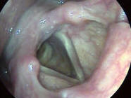 Normal Larynx or Voice Box