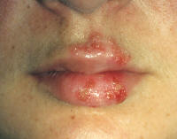 Cold Sores Caused by Herpes Simplex Virus