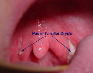 Acute Exudative Tonsillitis