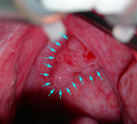 Large Oral Papilloma
