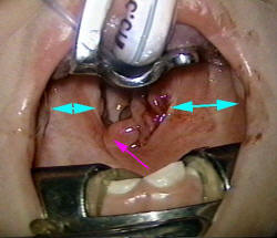 Peritonsillar Abscess - Quinsy Tonsillectomy