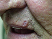 basal cell carcinoma of the lip