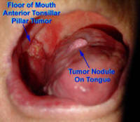squamous cell carcinoma of the mandible and tongue