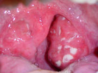acute tonsillitis from mononucleosis