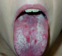 Mucositis caused by herpes simplex virus involving the tongue