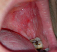 Appearance of the Buccal Cavity in a Patient with Lichen Planus 