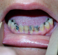 Dental Caries in a Patient with Lichen Planus 