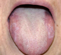 Lichenoid Reaction on the Tongue