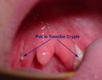 acute tonsillitis
