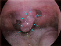 squamous cell carcinoma of the uvula