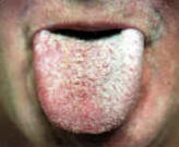 hairy tongue after treatment