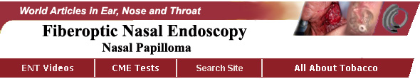 Nasal endoscopy in a patient with nasal polyps